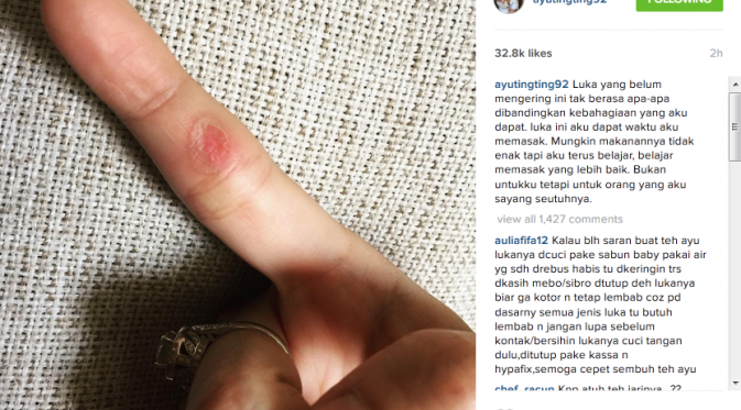 Jemari  Ayu Ting Ting yang terluka. (Instagram @ayutingting92)