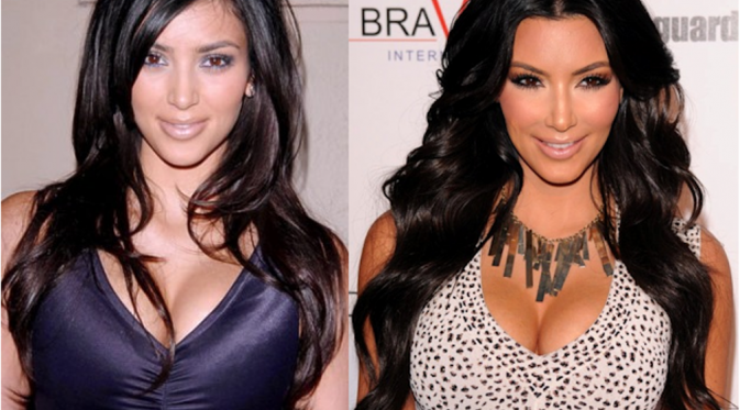 Kim Kardashian, Satu dari 10 Selebritis yang Telah Operasi Plastik | via: 3dfirstaid.tv