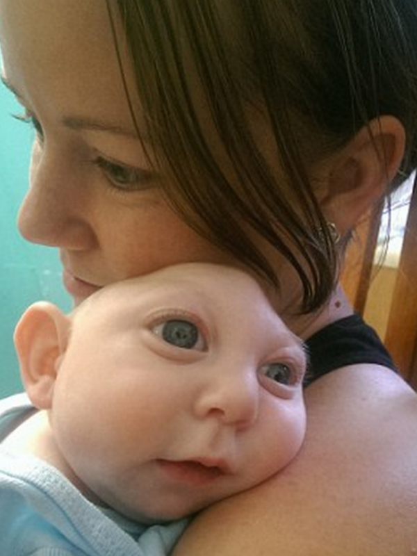 Bayi Ini Terlahir dengan Tempurung Kepala yang Tidak Sempurna | via: 