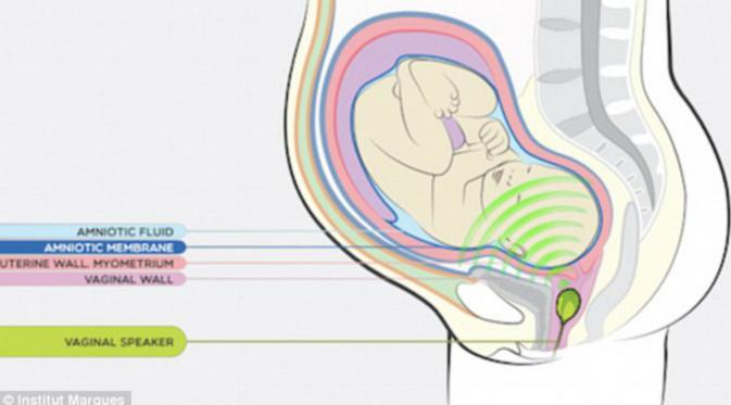 Perangkat babypod dimasukkan ke dalam vagina, untuk memungkinkan bayi yang belum lahir untuk mendengarkan musik
