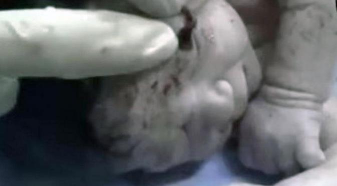 Bayi Suriah Ini Lahir dengan Pecahan Peluru Menancap di Dahi | via:independent.co.uk