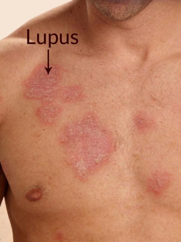 Ini dia beberapa hal tentang penyakit lupus yang mungkin belum kamu ketahui. 