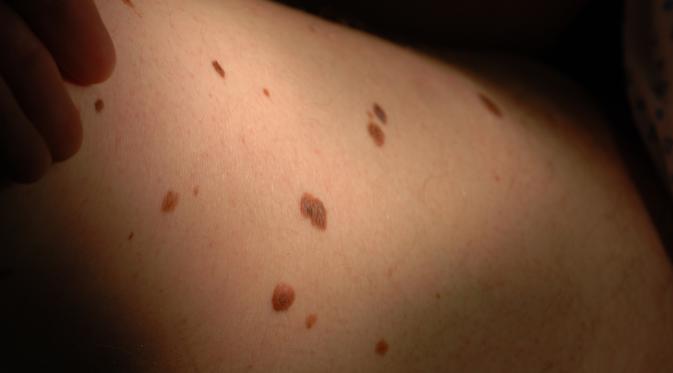 Tapi, kalau lebih dari 11 di lengan kanan bisa menjadi indikasi kanker kulit. (Via: whatclinic.com)