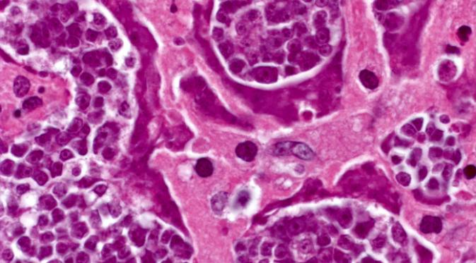 Sel-sel tumor ganas dalam dalam cacing pita yang kemudian menyebar kepada pasien. (Sumber CDC)