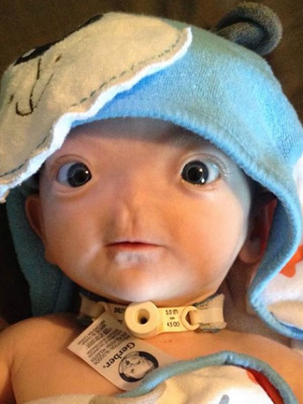 Eli, bayi yang terlahir tanpa hidung. | via: tvm.com.mt