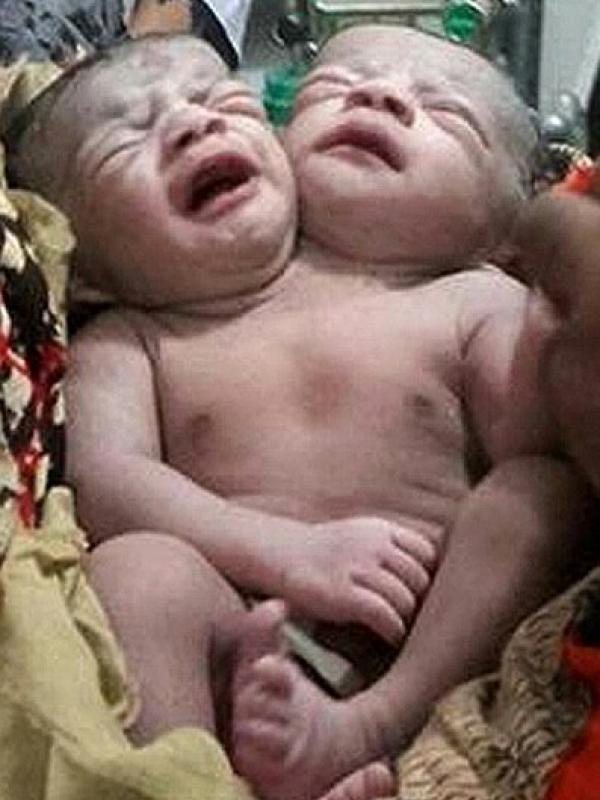 Saling Berbagi Tubuh, Bayi Ini Terlahir dengan Dua Kepala | via: dailymail.co.uk