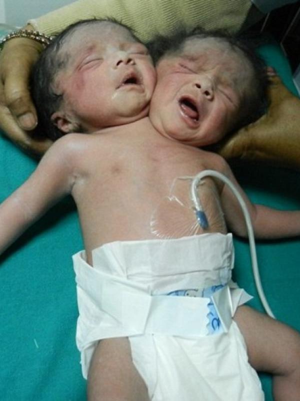 Saling Berbagi Tubuh, Bayi Ini Terlahir dengan Dua Kepala | via: khaama.com