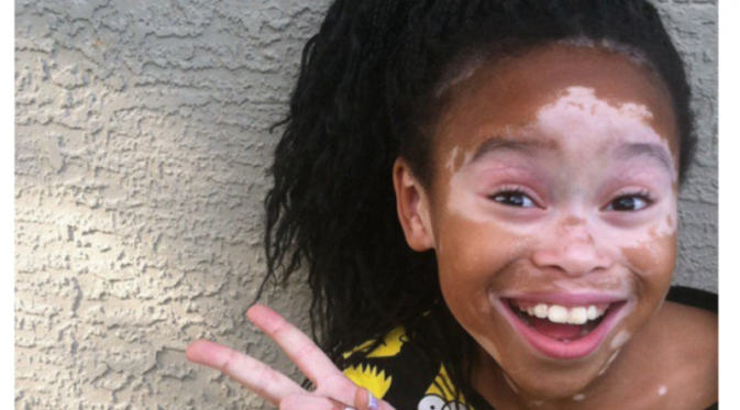 Kelainan kulit bernama Vitiligo, gadis cilik ini jadi model. (Foto: Buzzfeed)