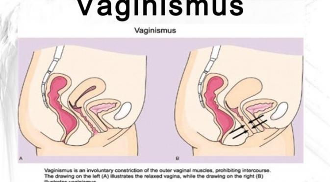 Penjelasan vaginismus. (Via: slideshare.net)