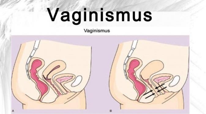 Penjelasan vaginismus. (Via: slideshare.net)