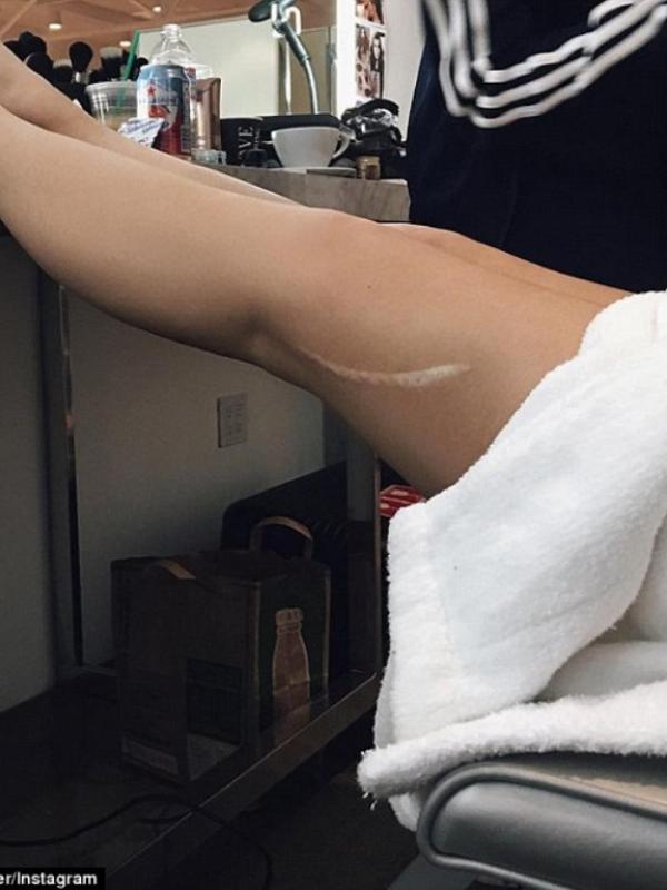 Bekas luka Kylie Jenner. Sumber: Instagram/kyliejenner