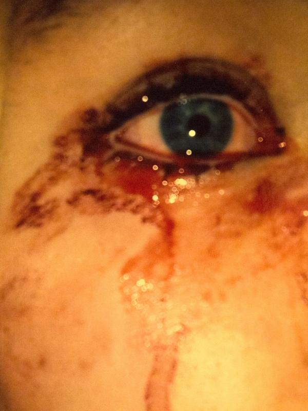 Darah Keluar dari Mata, Gadis Ini Punya Penyakit Misterius | via: thesun.co.uk