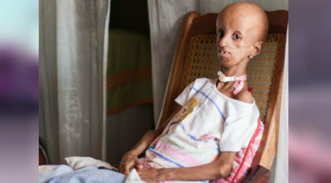Hutchinson-Gilford Progeria Syndrome yakni kelainan genetik langka yang menyebabkan anak-anak mengalami penuaan diri scara berlebihan.