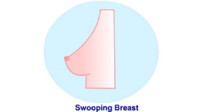 Swooping Breasts  (sumber, medindia.net)