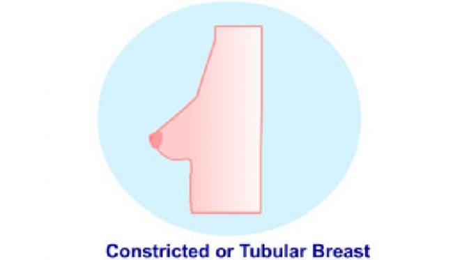 Constricted atau Tubular Breast (sumber, medindia.net)