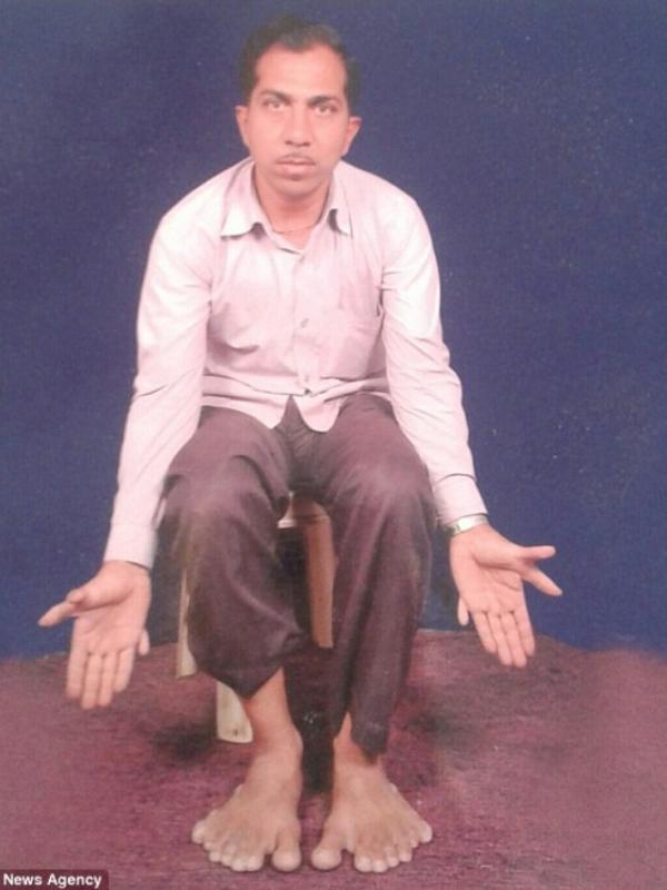 Devendra Suthar, laki-laki dengan jumlah jari 28 buah. | via: Caters News Agency