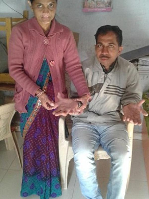Devendra Suthar (kanan), laki-laki dengan jumlah jari 28 buah. | via: Caters News Agency
