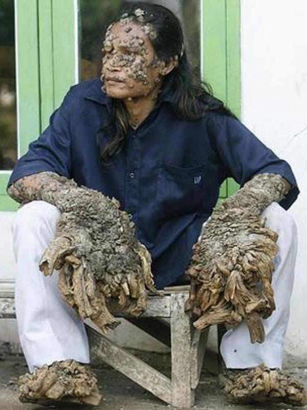 Dede 'manusia akar' sebelum operasi di tahun 2008. | via: ecofrenhealth.wordpress.com