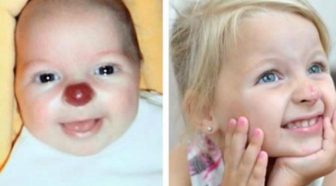 Lain halnya dengan Connie. Bocah 2 tahun ini memilki tanda lahir pada hidung dengan bentuk bulat, besar, merah seperti hidung badut. (Oddee.com)
