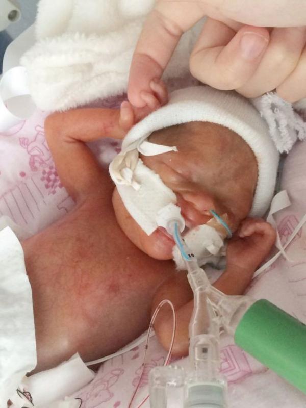 Lydia, bayi yang terlahir 15 minggu lebih awal. (Via: mirror.co.uk)