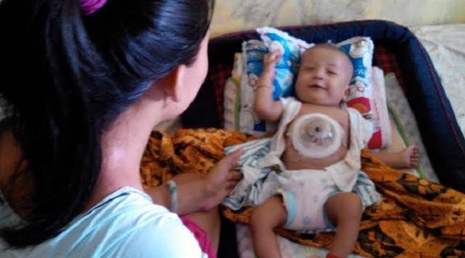 Bayi dengan kondisi jantung di luar di Semarang (Liputan6.com/Felek Wahyu)