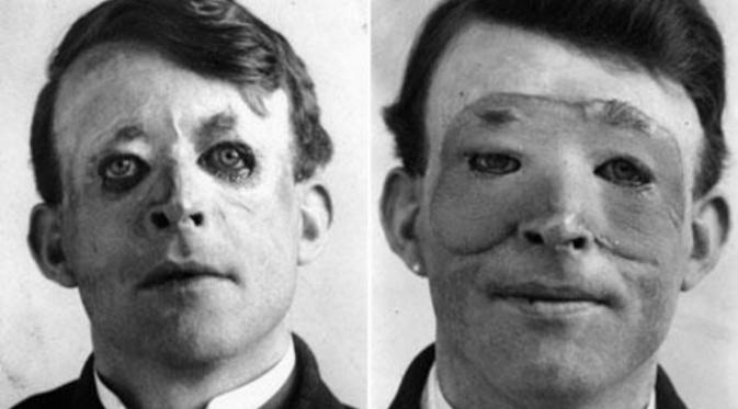 Rekonstruksi wajah oleh Harold Gillies (Foto: Wikipedia).