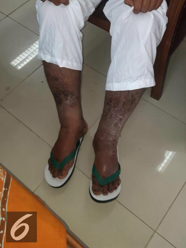 Kondisi kaki ayah Marshanda, Irwan Yusuf, yang mengalami luka serius. [Foto: Rizky Aditya Saputra/Liputan6.com]