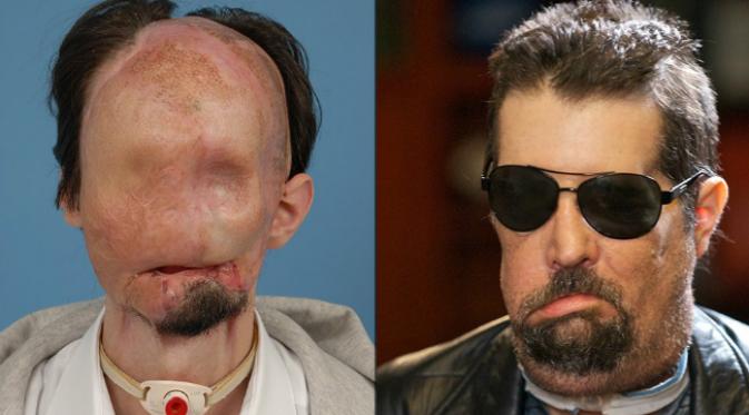 Dallas Wiens harus menjalani transplantasi wajah karena terbakar. (Sumber CNN)