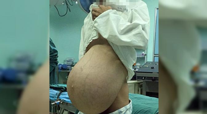 Tumor pada bagian perut mencapai hingga 15 kilogram. (dailymail)