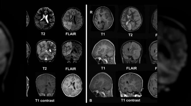 Pemindaian MRI pada otak penderita ensefalitis Rasmussen/ (Sumber techinsider.io)