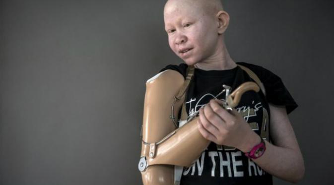 Seorang penderita albinisme (kekurangan pigmen) diincar untuk dijadikan ritual korban manusia dan diambil bagian-bagian tubuhnya. 