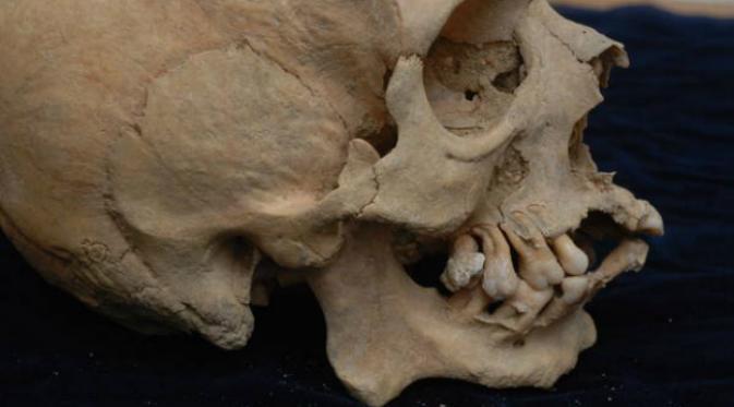 Ilustrasi tengkorak manusia Romawi Kuno dengan kerusakan tulang hidung. (Sumber ANSA.it)
