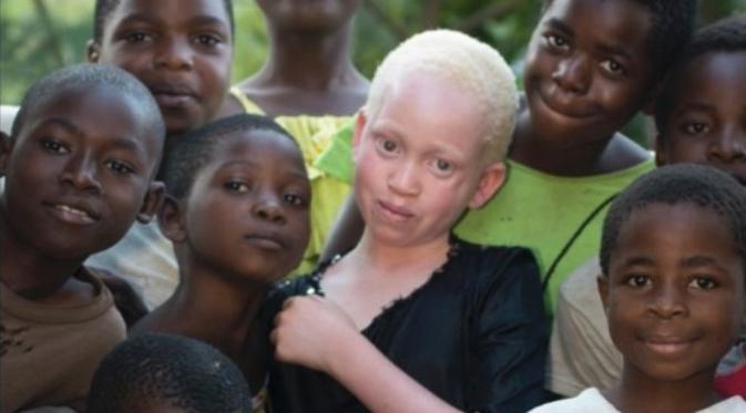 PBB menyatakan, jika pembunuhan albino terus berlanjut, mereka akan segera 'punah' (Amnesty/BBC)