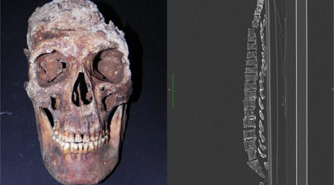 CT scan dan sinar-X dilakukan untuk menganalisa tulang Pacchierotti (Alberto Zanatta/Scientific Reports)