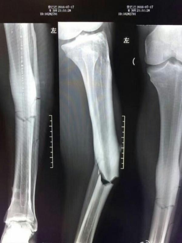 Kondisi tulang kaki Demba Ba usai mendapat tackling brutal lawan.