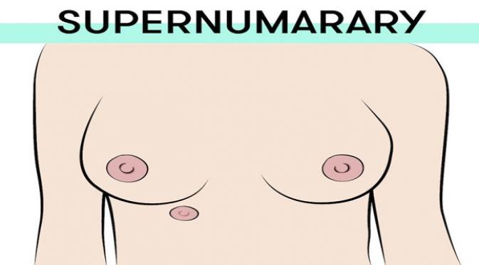 The Supernumarary Nipple. Sumber : yourtango.com