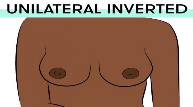 The Unilateral Inverted Nipples. Sumber : yourtango.com