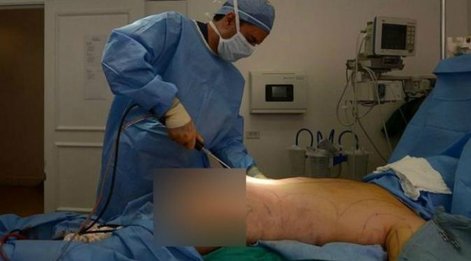Seorang dokter sedang melakukan prosedur pembesaran bokong (AFP)
