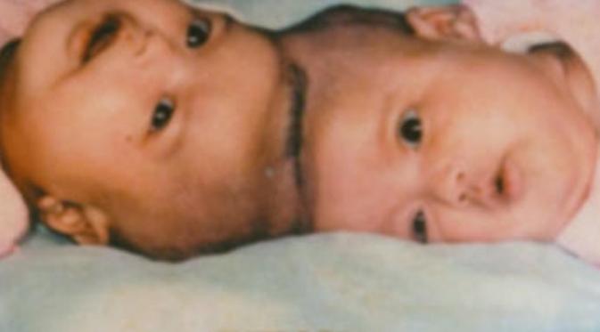 Bayi kembar siam Yuliana dan Yuliani. (via: istimewa)
