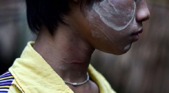 Terlihat sejumlah luka di bagian leher remaja perempuan ini (AFP)
