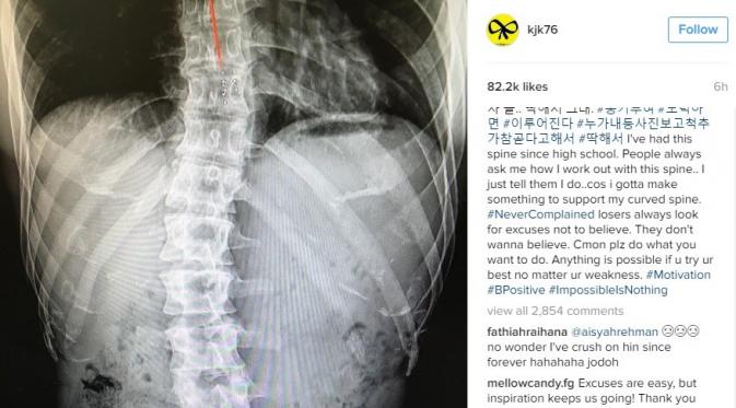 Kim Joong Kook ungkap dirinya menderita skoliosis. (Instagram/kjk76)