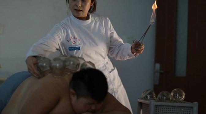 Bekam api, jadi salah satu terapi pada bocah obesitas asal Tiongkok. (Foto: Daily Mail)