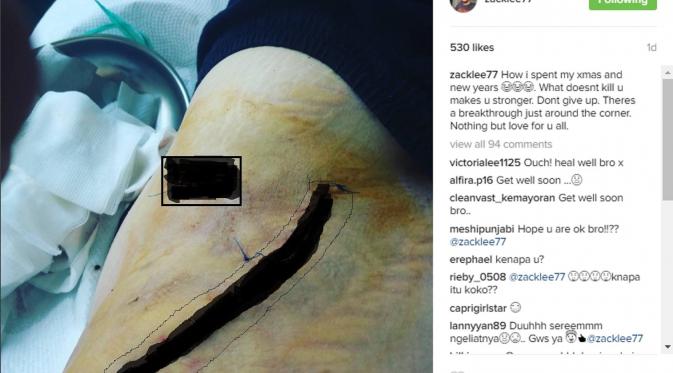 Kondisi luka yang dijahit (sensor) Zack Lee disebut lantaran mengalami kecelakaan. (Instagram @zacklee77)