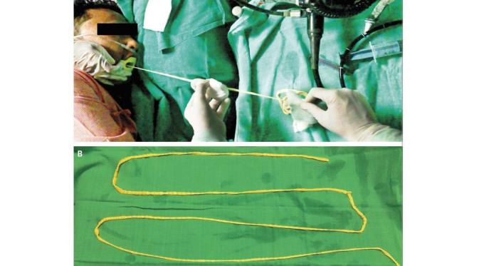 Cacing pita babi yang dikeluarkan dari usus seorang pria. (Live Science)