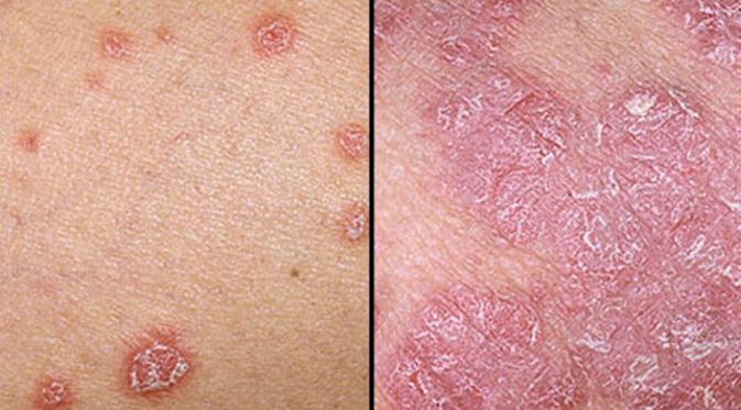 Penyakit psoriasis yang membuat kulit menimbulkan ruam merah serta bersisik. (via: onehealth.com)