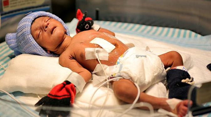 Bayi berhasil menjalani operasi dan menjadi manusia normal. (Foto: Mail Online)