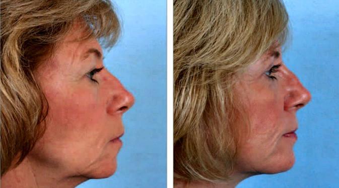 Operasi tarik wajah memengaruhi penampilan wanita. (Foto: Telegraph)