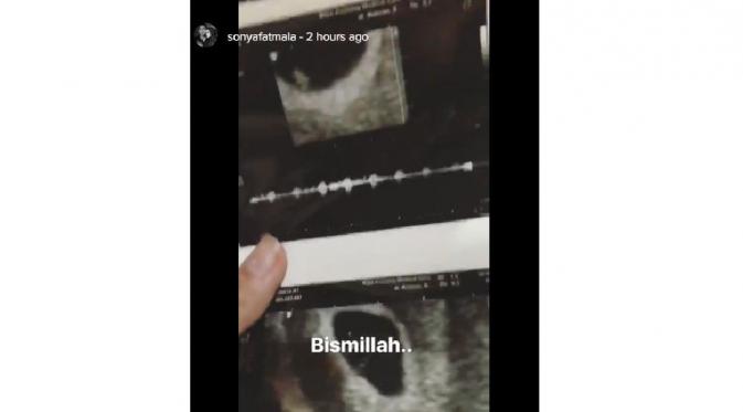 Sonya Fatmala hamil anak kedua?