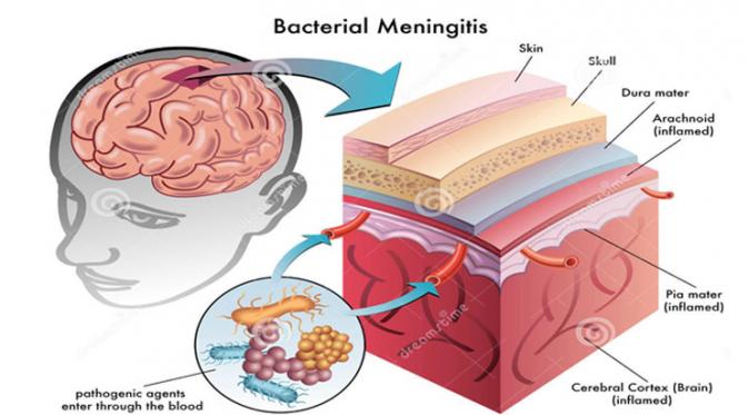 Perkembangan virus meningitis terus meningkat di berbagai belahan dunia. Karena alasan tersebut WNI yang keluar negeri wajib vaksin.