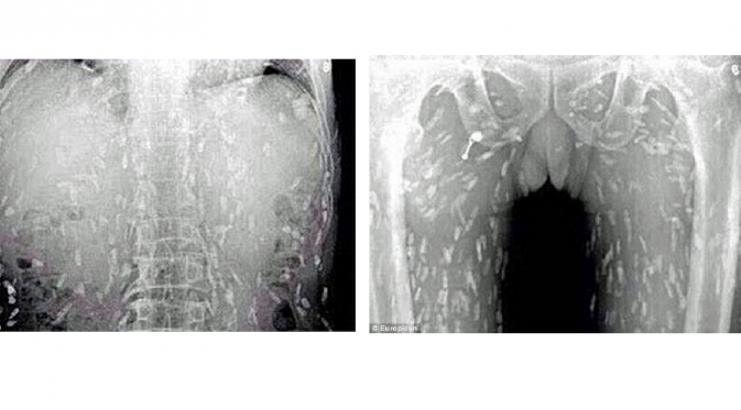 Gambar x-ray penikmat sashimi terinfeksi cacing pita. (Youtube)